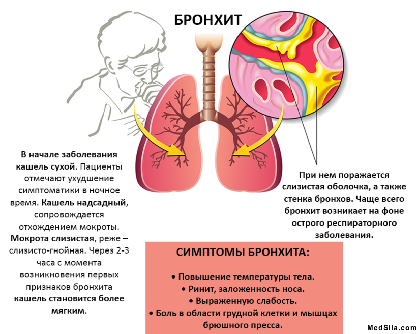 Симптоматика бронхита